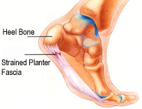 heel pain